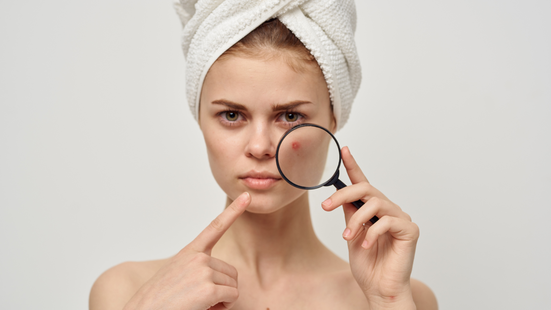 Understanding Acne: Causes, Treatments, and Preventative Measures